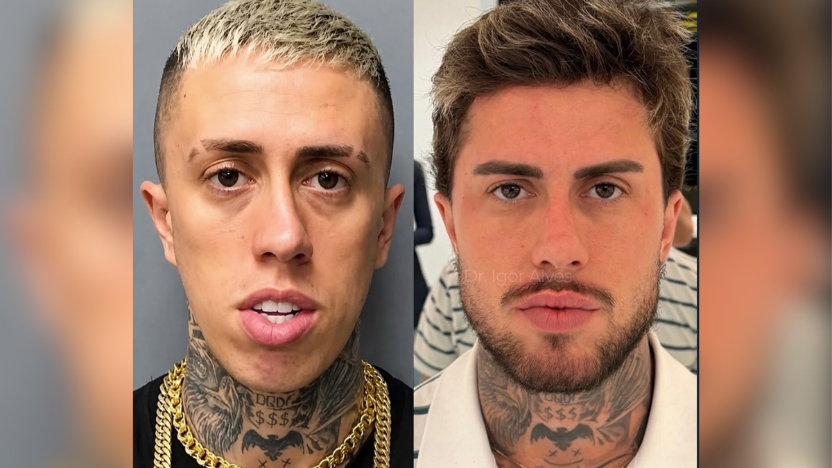 Especialista revela detalhes da harmonização facial de MC Daniel e expõe pedido do cantor