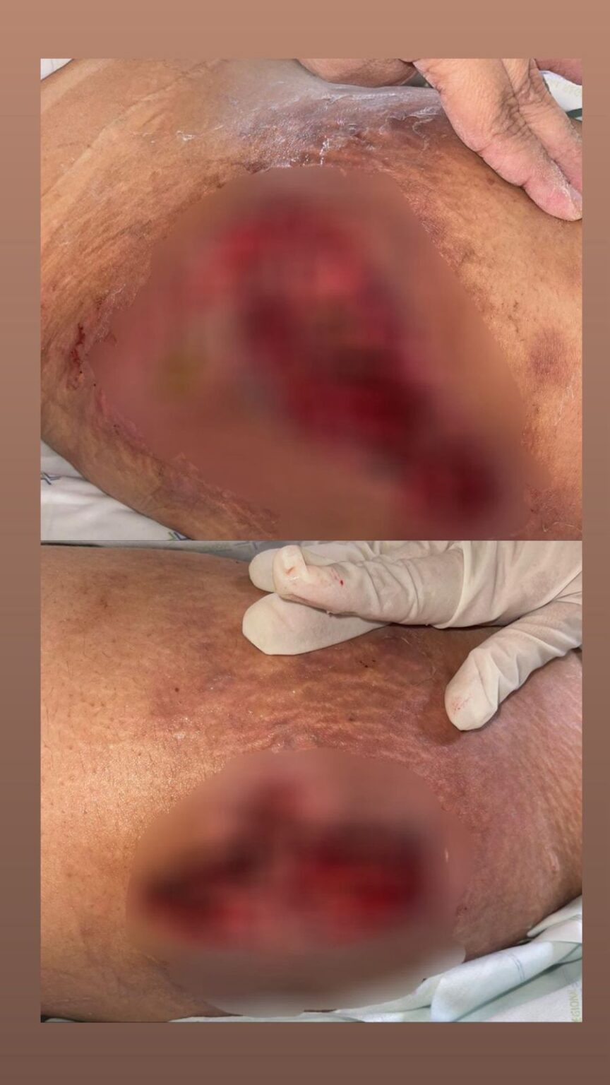 Dentista é presa após aplicar silicone industrial em mulheres e causar lesões graves em Alagoas